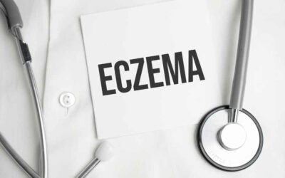 Eczema Frequently Asked Questions